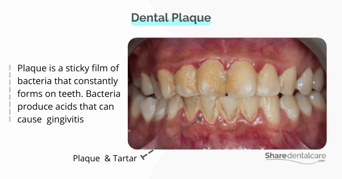 Dental plaque and gingivitis