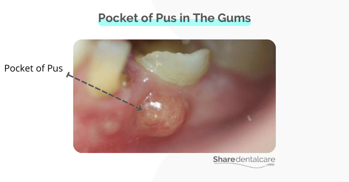 Pocket of pus in the gums