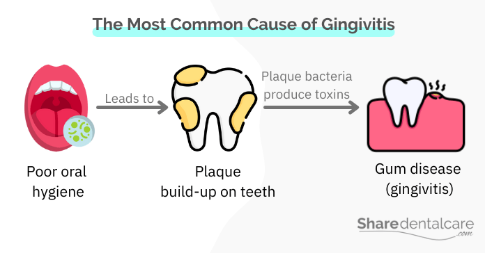 Poor oral hygiene and gingivitis