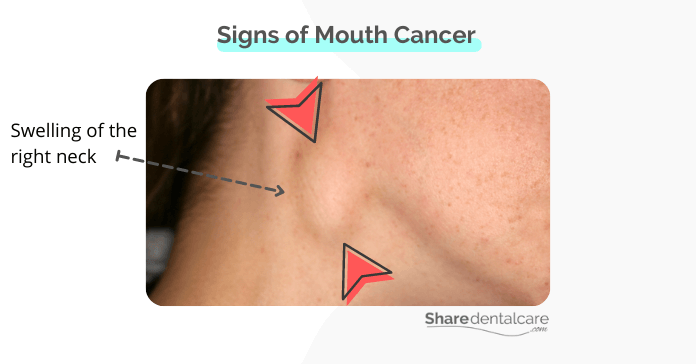 Signs of mouth cancer start
