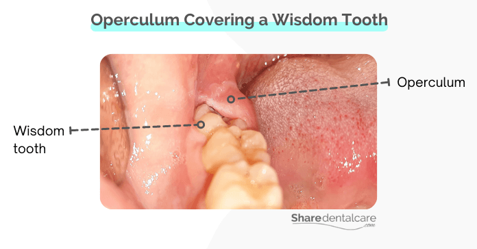 Operculum covering a wisdom tooth