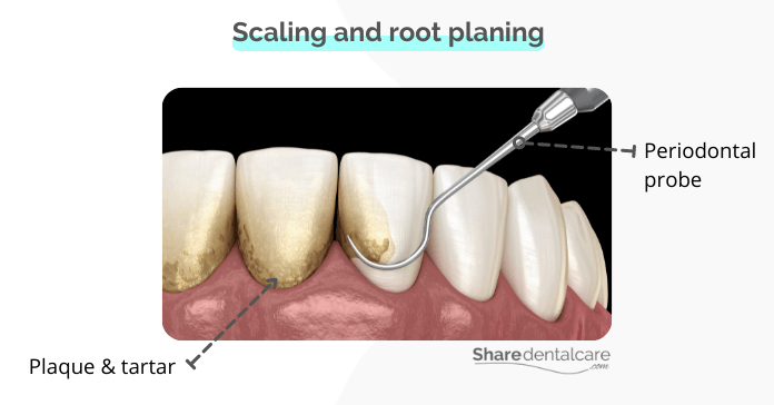 Scaling and root planing for swollen gum pocket
