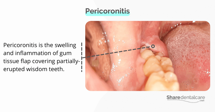 Pericoronitis (inflamed operculum)