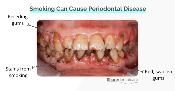 Smoking can cause periodontal disease