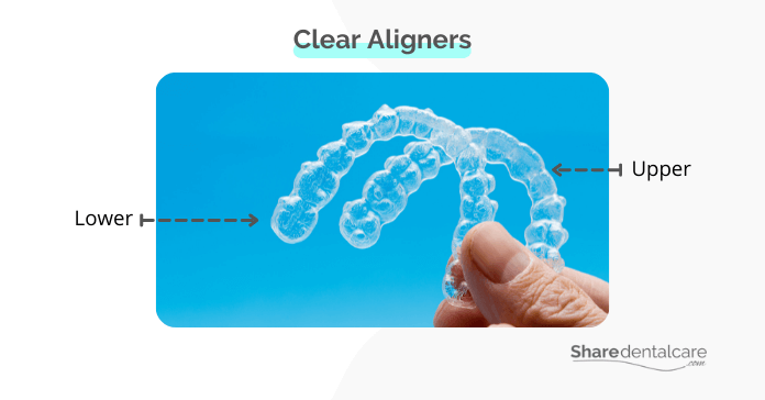 Clear aligners for mild teeth crowding