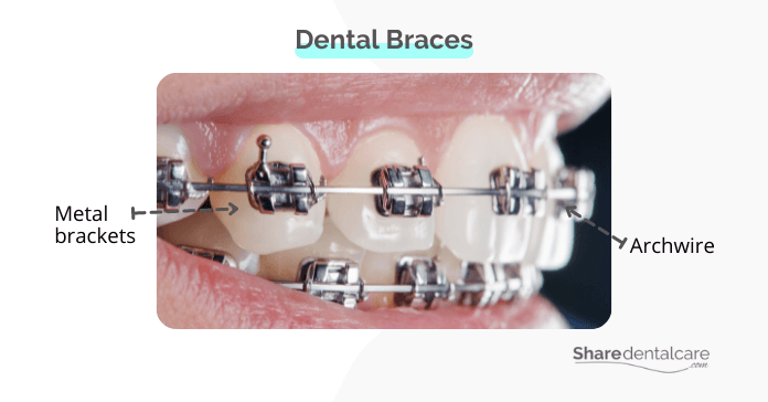 Dental braces for minor teeth crowding