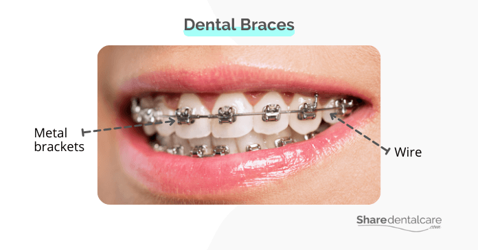Dental braces for severely crowded teeth