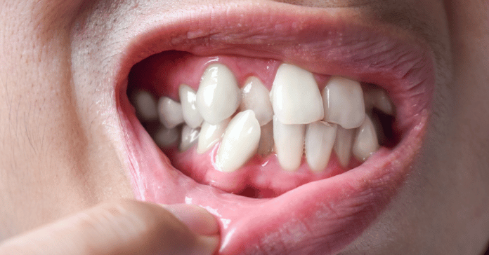 Close-up of crowded teeth showing severe dental misalignment and overlapping anterior teeth.