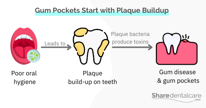 Gum Pockets start with plaque buildup