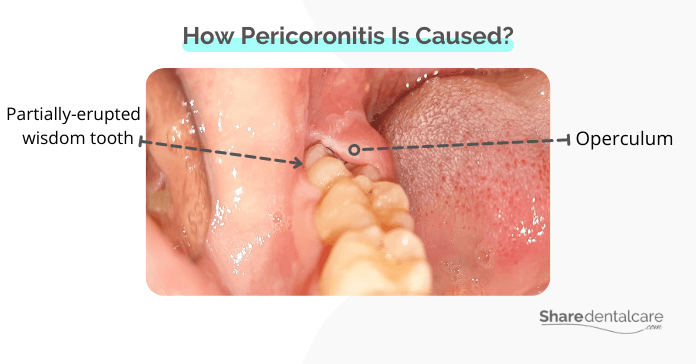 How pericoronitis is caused without wisdom teeth