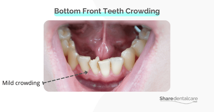 Mild bottom front teeth crowding