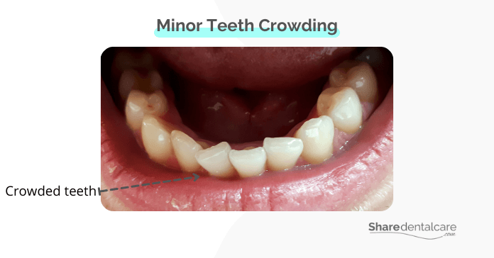 Minor teeth crowding