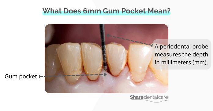 What does 6mm gum pocket mean?