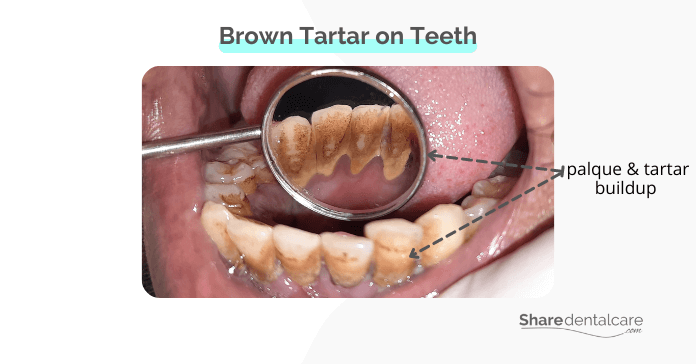 Brown tartar buildup on teeth