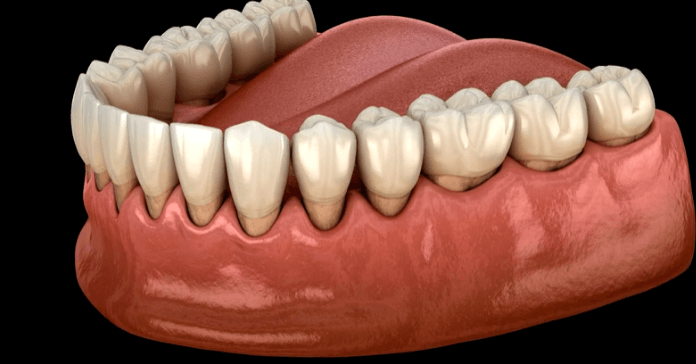 Illustration showing gum recession and the formation of spaces between teeth.