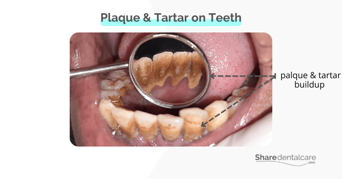 Plaque & Tartar on Teeth