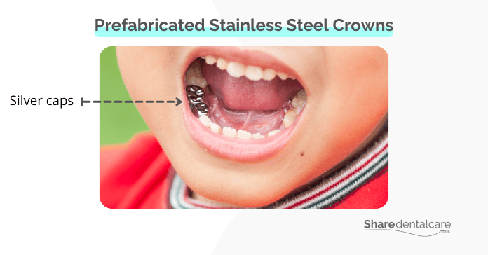 Prefabricated Stainless Steel Crowns (Silver Caps)