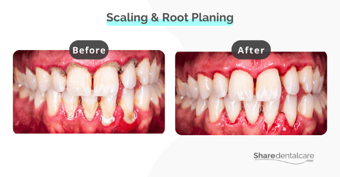 Scaling and root planing