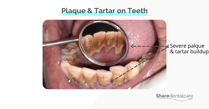Severe plaque and tartar on teeth