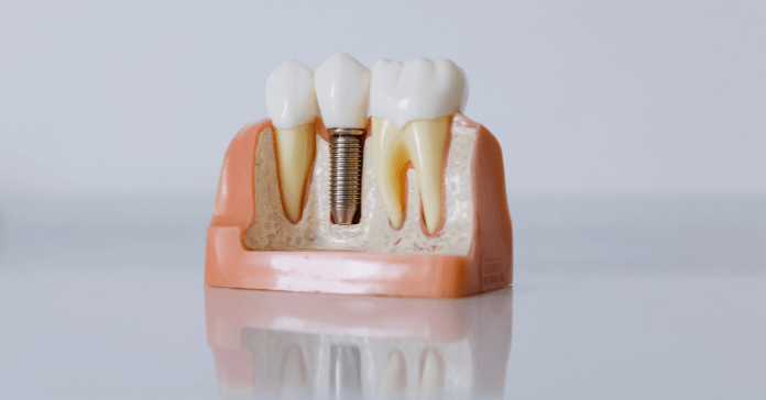 Model showing a dental implant placed in the jaw with surrounding teeth.