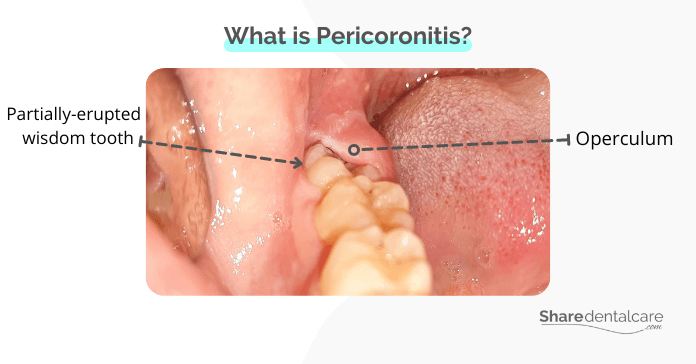 What is Pericoronitis?