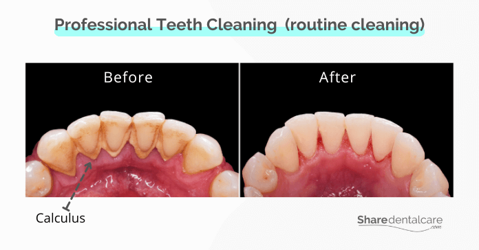 Professional teeth cleaning for heavy calculus