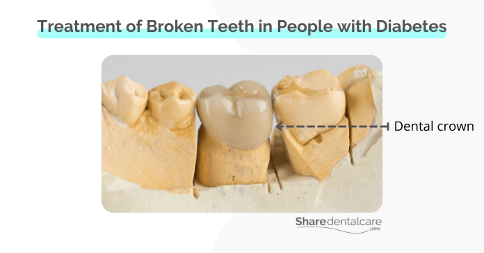 Crowns can prevent further teeth breaking in people with diabetes