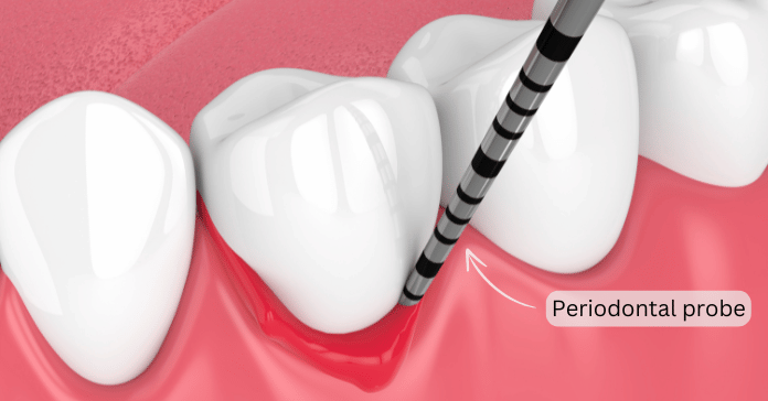 A periodontal probe measuring the depth of a gum pocket between teeth.
