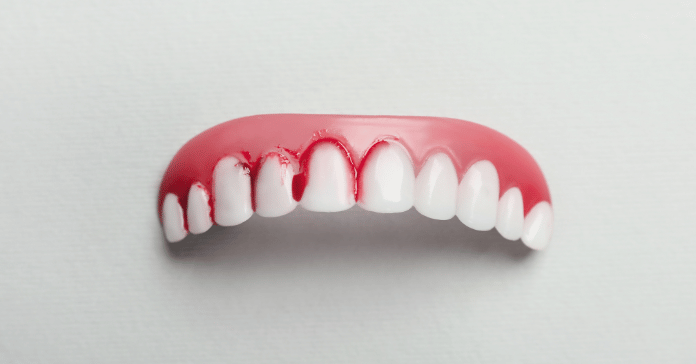 Dental model showing bleeding gums as a sign of gum disease or poor oral hygiene.
