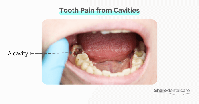Horrible Tooth Pain from Cavities