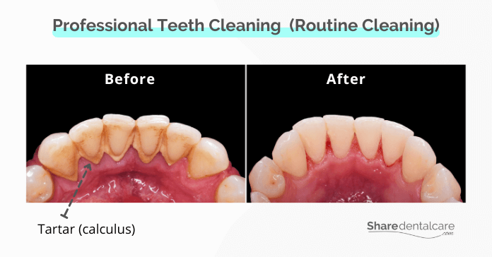 Professional teeth cleaning to treat periodontal (gum) disease.