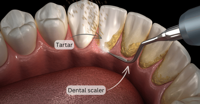 3D illustration of dental scaler removing tartar buildup from teeth during gum pocket treatment.