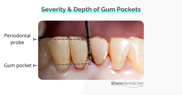Severity & Depth of Gum Pockets
