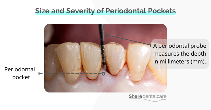 Size and Severity of Periodontal Pockets