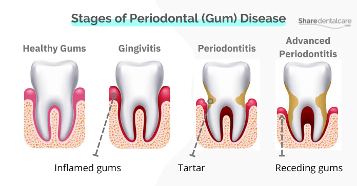 Stages of Periodontal (Gum) Disease