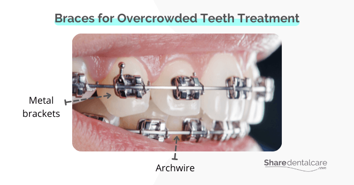 Braces for Overcrowded Teeth Treatment