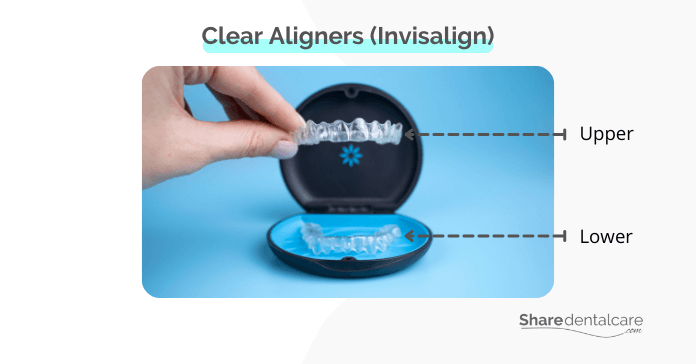 Clear Aligners (Invisalign)