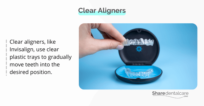 Clear aligners (Invisalign)
