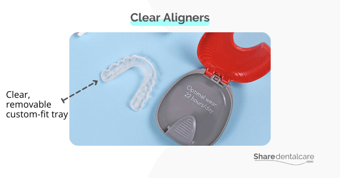 Clear aligners for misalignment issues