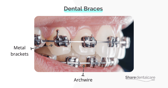 Braces for teeth crowding issue