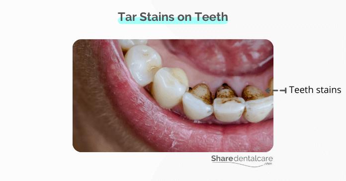 tar Contributes to teeth stains