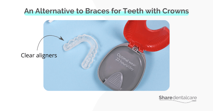 An alternative to braces for teeth with crowns