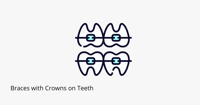 High-Quality Can You Get Braces With A Crown Artwork Illustration High-Quality Can You Get Braces With A Crown Artwork Illustration