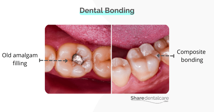Replacing the old amalgam filling with a composite (dental bonding).