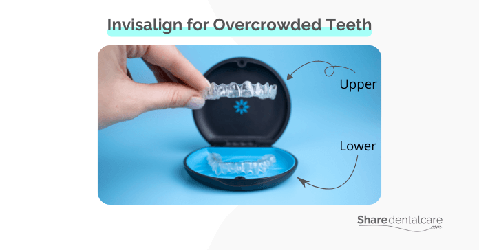 Invisalign for Overcrowded Teeth