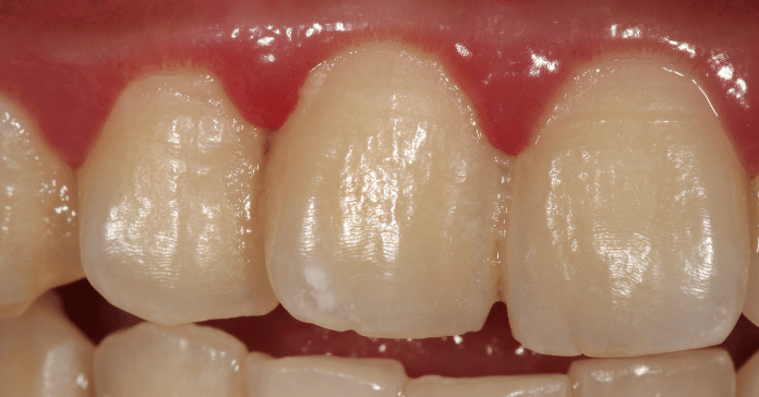 Close-up of mild gum infection with red and swollen gums near the upper front teeth.