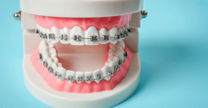 Tooth model with metal dental braces on both upper and lower teeth for orthodontic demonstration.