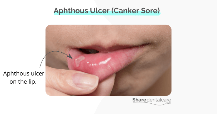 Aphthous Ulcer (Canker Sore)