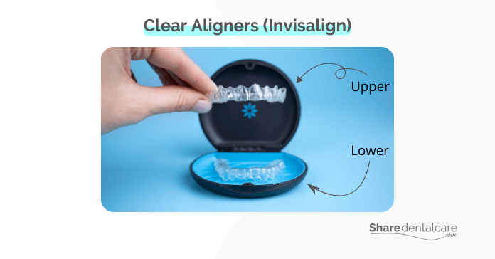 Clear aligners (Invisalign), an alternative to braces