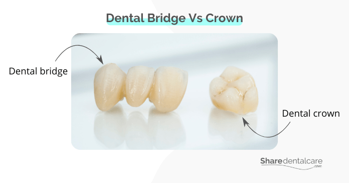 Braces with bridges vs. crowns